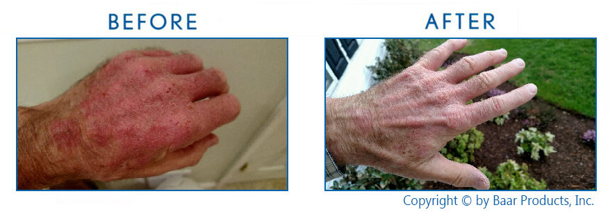 before and after eczema results
